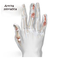 Artrita psoriazică