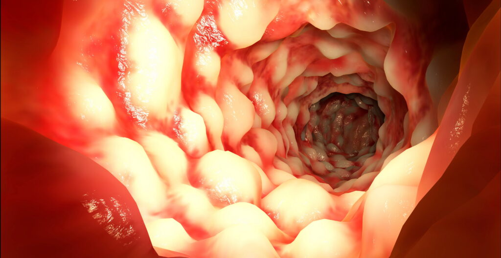 Boala Crohn