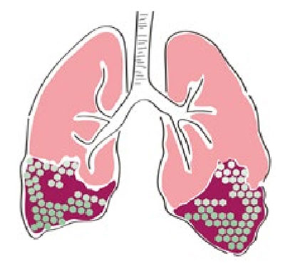 FPI – Fibroza pulmonară idiopatică